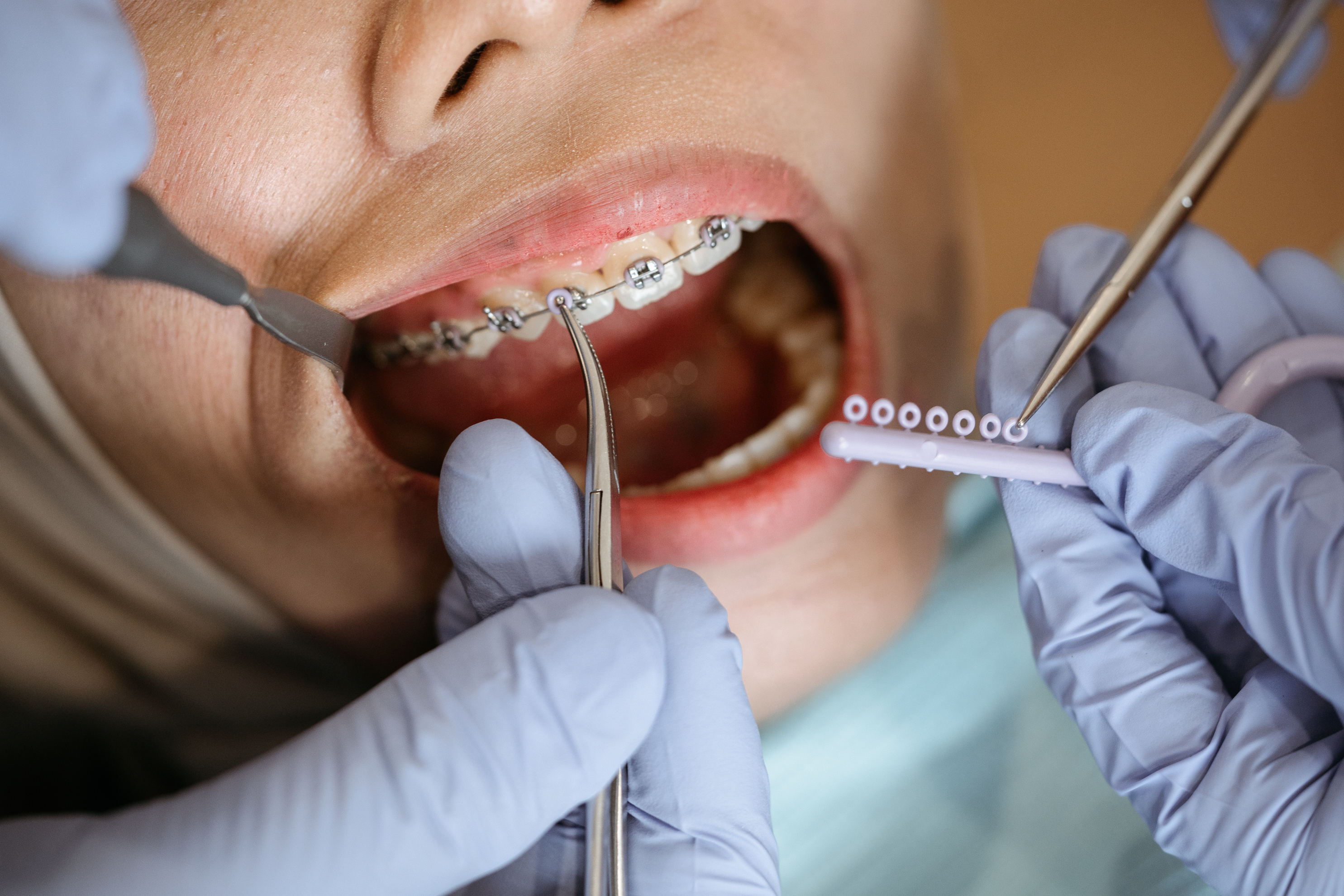 Pemasangan Alat Ortodonti