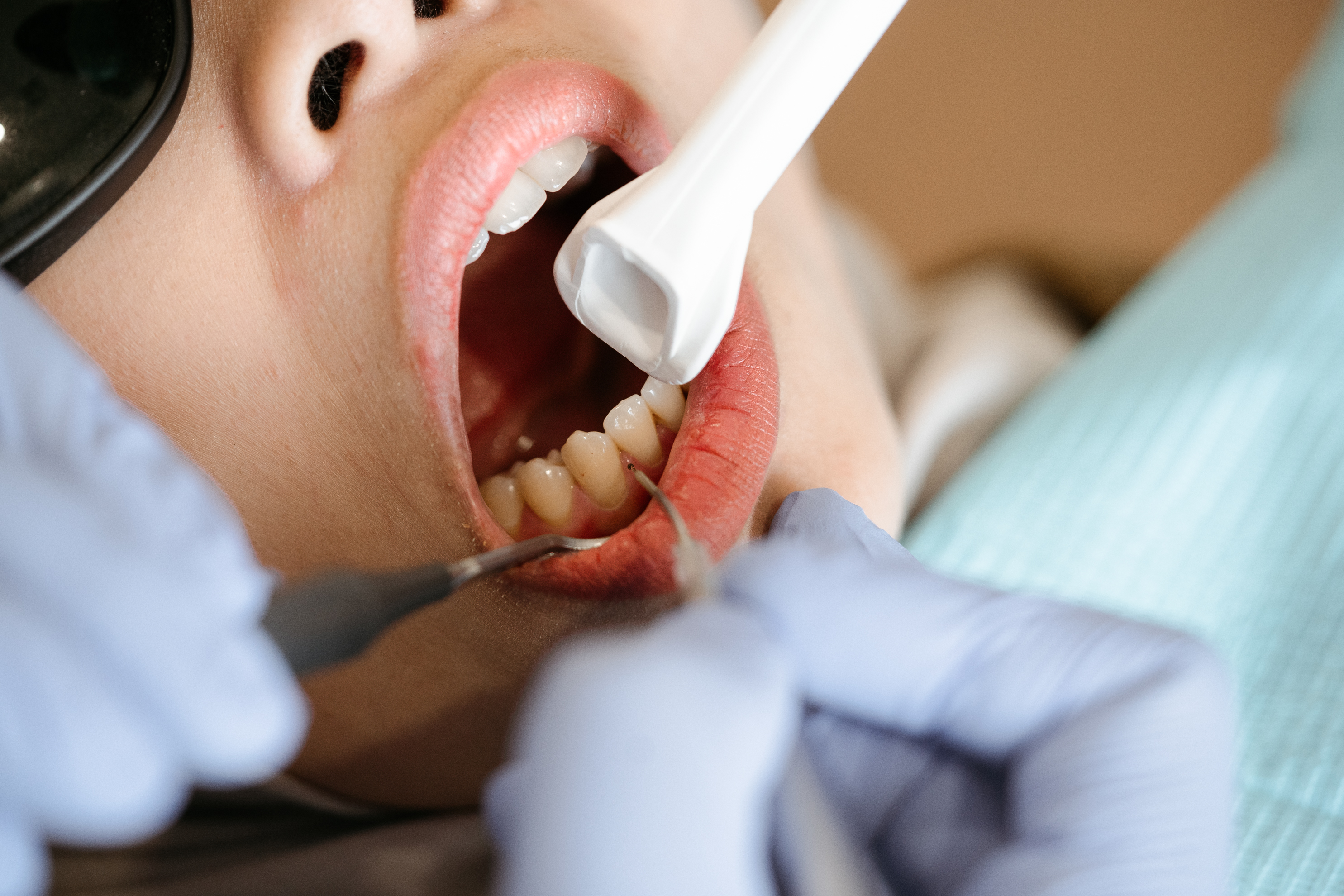 Scaling & Root Planing